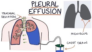 Understanding Pleural Effusions [upl. by Adnilg478]