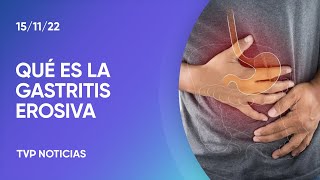 Síntomas de la gastritis erosiva con sangrado [upl. by Ariew61]