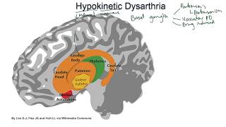 Hypokinetic Dysarthria  examples and tutorial [upl. by Hilde]