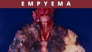 Empyema Causes Symptoms Treatment and Prevention [upl. by Hadleigh]