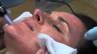 Dr Mark B Taylor Review of Dermapen Micro Needling  Gateway Aesthetics [upl. by Wieche]