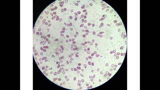 microcytic hypochromic anaemia [upl. by Ellehcen272]