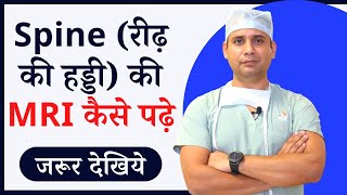 how to read spine mri at home  Dr naveen ne samjhaya scitica me mri kaise pata chalta hai [upl. by Anurb799]