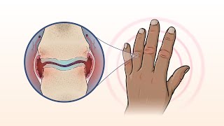 What Is Rheumatoid Arthritis  NEJM [upl. by Astrea529]