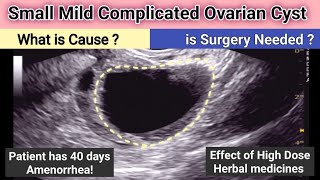 Ultrasound Mild Complicated Small Ovarian Cyst  what is Cause  is Surgery needed [upl. by Parent]