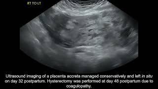 Placenta accreta spectrum conservative management and coagulopathy [upl. by Saturday597]