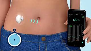 What is Continuous Glucose Monitoring CGM [upl. by Edward]