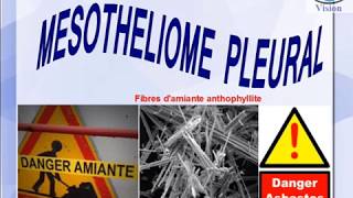 Mésothéliome pleural et les Produits contenant de lAmiante [upl. by Melinde]