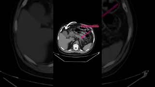 Acute calculus cholecystitis [upl. by Aix406]