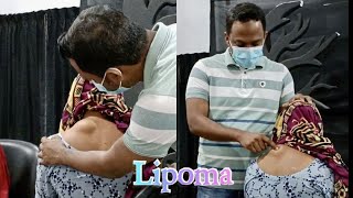 Lipoma  surgery  bangla [upl. by Aimak]