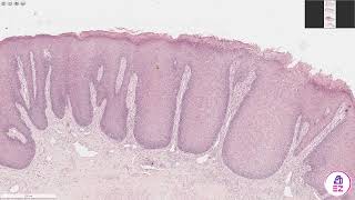 Chronic Hyperplastic Candidiasis [upl. by Essiralc]