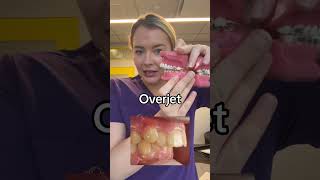 Overjet vs overbite braces overbite overjet [upl. by Alyam]