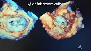 Necrose caseosa no anel mitral Componente móvel em face Ventricular [upl. by Kluge]