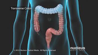 Colon Problems Diverticular Disease [upl. by Buderus]