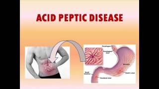 Acid Peptic Disease Presentation [upl. by Gentry]