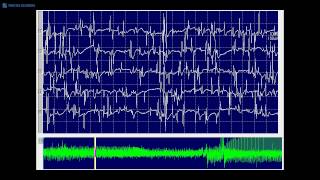 Kimura amp Kohara F20 Myotonic discharges mixed with spontaneous single muscle fiber discharges [upl. by Relyk]