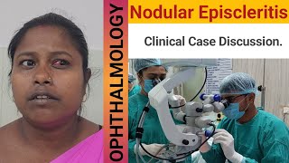 Nodular Episcleritis  Educational Video  Case study  Ophthalmology [upl. by Ecirted]