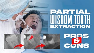 quotPartial Wisdom Tooth Extraction Pros amp Consquot [upl. by Yarod]