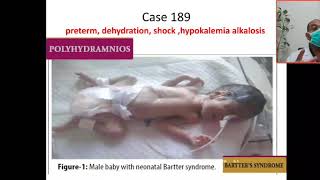 Case 189 hypokalemic metabolic alkalosis Bartter syndrome hyperprostaglandin Syndrome hypercalciu [upl. by Sutsugua]