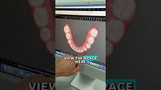 Invisalign to close spaces and gaps [upl. by Bridget]