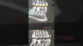 Dental cyst radiology حويصلات الفكين [upl. by Adolphe]