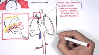 Lung Carcinoma Lung cancer [upl. by Aden]