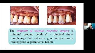 Resective Osseous Surgery online Lecture [upl. by Donaghue]