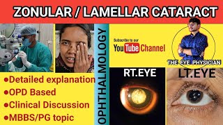 ZONULAR  LAMELLAR CATARACT  OPHTHALMOLOGY  EDUCATIONAL VIDEO [upl. by Aubarta]