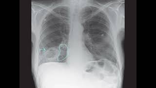 Deciphering a Mysterious Lung Lesion Radiology Case Analysisquot [upl. by Cirilo]