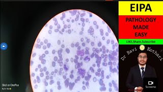 EDTA induced Platelet Aggregates  EIPA  drravikotharipathology  MD Pathology [upl. by Monk]