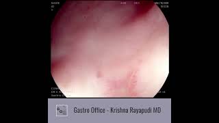 Gastric Ulcer video [upl. by Aicilf]