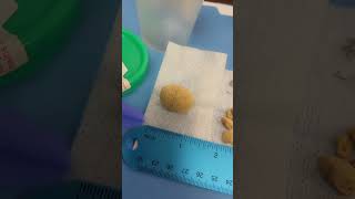 Gallstones Cholelithiasis surgicalremoval abdomen realgallstones medicaleducation mzruiz [upl. by Lleznol]