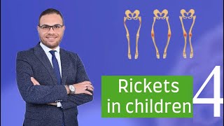 Rickets lecture part 4  لين العظام في الاطفال [upl. by Aninep]