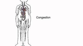 How heart failure causes fluid accumulation  wwwheartfailuremattersorg [upl. by Mohorva]