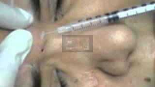 Relax with Botox Injections  egypt حقن البوتكس  مصر [upl. by Terr62]