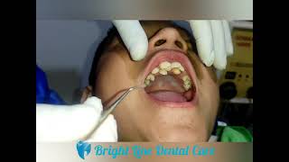 Mesiodens  2 Supernumerary Tooth  Extraction  DrSwostik Devkota  Bright Line Dental Care Nepal [upl. by Anemij]