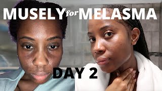 Musely Spot Cream for Melasma Day 2 [upl. by Frulla]