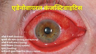 एडेनोवायरल कंजक्टिवाइटिस adenoviral conjuctivitiesआँखों में लाली Redness Itching and Burning [upl. by Elyagiba]