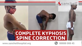 Complete Kyphosis Spine Correction Surgery using Oarm technology  Pre amp Post Surgery [upl. by Yasmine]