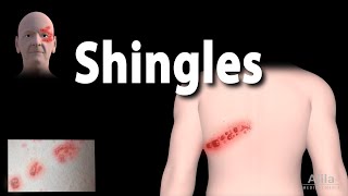 Shingles Pathophysiology Symptoms 3 stages of Infection Complications Management Animation [upl. by Annohsat]