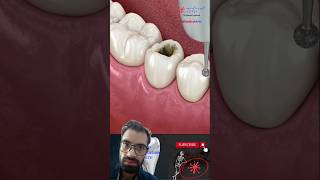 Dental Restoration ↪ Composite Bonding Teeth ↪ 3D Medical Animation [upl. by Acirrehs]