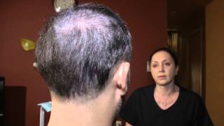 Scalp Micropigmentation  fixing the problem [upl. by Valeda]