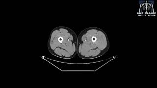 ANGIOSCANNER DE L’AORTE ET DES MEMBRES INFERIEURS Fracture complexe de la jambe [upl. by Eloc959]