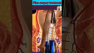 Hemorrhoids surgery suture techniques shorts doctor motivation piles 3D animation shortsstatus [upl. by Zobkiw839]