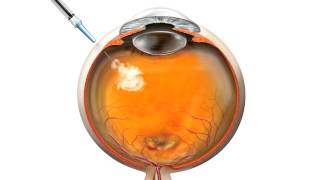 Anti VEGF Injection for macular degeneration [upl. by Phaidra618]