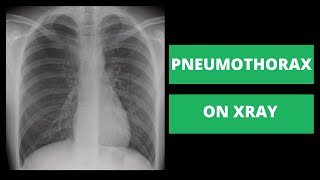 How to Identify a Pneumothorax on Xray  Strategies from a Radiologist [upl. by Fonsie]