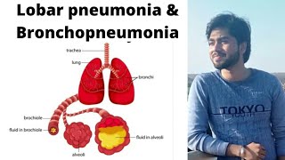 Pneumonia  Lobar pneumonia and BronchopneumoniaBy Abhishek sir [upl. by Nauquf21]