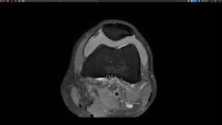 Knee injury LCL Bursa [upl. by Itnava]