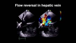 Echocardiography Essentials Spotting tricuspid and pulmonary valve disease [upl. by Scarface]