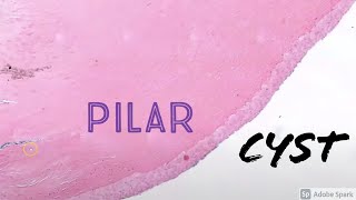 Trichilemmal CystPilar Cyst 5Minute Pathology Pearls [upl. by Bamford]